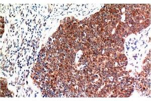 Immunohistochemistry of paraffin-embedded Human breast carcinoma tissue using BECN1 Monoclonal Antibody at dilution of 1:200. (Beclin 1 Antikörper)