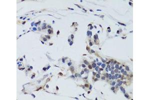 Immunohistochemistry of paraffin-embedded Human gastric cancer using DNMT1 Polyclonal Antibody at dilution of 1:200 (40x lens). (DNMT1 Antikörper)