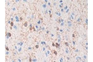 Detection of TPPP in Human Glioma Tissue using Polyclonal Antibody to Tubulin Polymerization Promoting Protein (TPPP) (Tppp Antikörper  (AA 8-210))