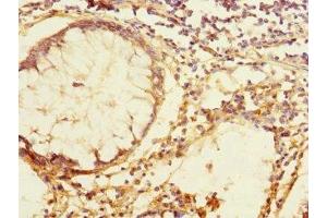 Immunohistochemistry of paraffin-embedded human colon cancer using ABIN7171814 at dilution of 1:100 (TEX43 Antikörper  (AA 1-134))