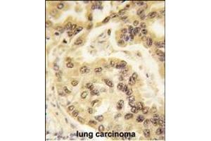 Formalin-fixed and paraffin-embedded human lung carcinoma tissue reacted with p53 Antibody  h , which was peroxidase-conjugated to the secondary antibody, followed by DAB staining.