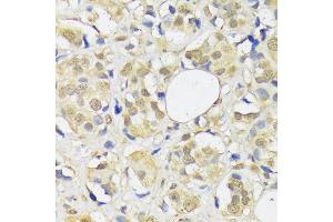 Immunohistochemistry of paraffin-embedded human breast cancer using  antibody (ABIN1678593, ABIN3018971, ABIN3018972 and ABIN6220651) at dilution of 1:100 (40x lens). (ADRM1 Antikörper  (AA 108-407))