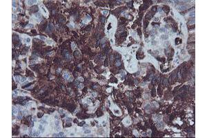 Immunohistochemical staining of paraffin-embedded Adenocarcinoma of Human ovary tissue using anti-AHSG mouse monoclonal antibody. (Fetuin A Antikörper)