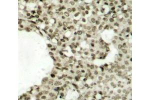 Immunohistochemistry of paraffin-embedded human breast carcinoma tissue, using Phospho-STAT1-S727 antibody (ABIN2988310). (STAT1 Antikörper  (pSer727))