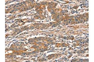 The image on the left is immunohistochemistry of paraffin-embedded Human gastic cancer tissue using ABIN7129096(CUEDC2 Antibody) at dilution 1/30, on the right is treated with fusion protein. (CUEDC2 Antikörper)