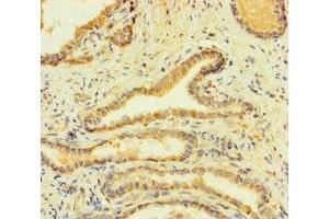 Immunohistochemistry of paraffin-embedded human prostate cancer using ABIN7155180 at dilution of 1:100 (Fc epsilon RI/FCER1A Antikörper  (AA 26-205))