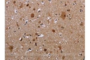 The image on the left is immunohistochemistry of paraffin-embedded Human brain tissue using ABIN7191347(MAGEB18 Antibody) at dilution 1/20, on the right is treated with synthetic peptide. (MAGEB18 Antikörper)
