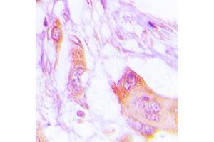 Immunohistochemical analysis of MARK staining in human lung cancer formalin fixed paraffin embedded tissue section.