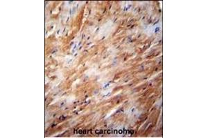 TFB2M Antibody (C-term) (ABIN654104 and ABIN2843988) immunohistochemistry analysis in formalin fixed and paraffin embedded human heart carcinoma followed by peroxidase conjugation of the secondary antibody and DAB staining. (TFB2M Antikörper  (C-Term))