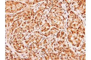 IHC-P Image Immunohistochemical analysis of paraffin-embedded A549 xenograft, using MID1IP1, antibody at 1:100 dilution. (m1ip1 Antikörper)