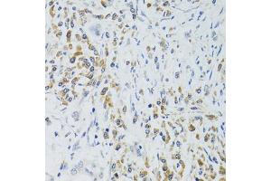 Immunohistochemistry of paraffin-embedded human colon carcinoma using SRP19 antibody (ABIN2560139) at dilution of 1:100 (40x lens). (SRP19 Antikörper)