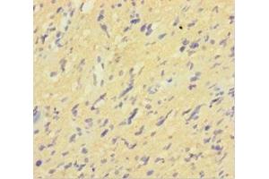 Immunohistochemistry of paraffin-embedded human glioma using ABIN7156965 at dilution of 1:100 (ISX Antikörper  (AA 1-245))