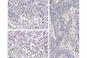 Immunohistochemistry of HumanIL1beta_antibod Tissue: medullary lymph node Fixation: formalin fixed paraffin embedded Antigen retrieval: user optimized Primary antibody: Human IL1beta antibody Secondary antibody: Peroxidase goat anti-rabbit at 1:10,000 for 45 min at RT Localization: cytoplasm Staining: Close up of medullary lymph node: positive staining in the cytoplasm of circulating macrophages. (IL-1 beta Antikörper  (Cleavage Site, N-Term))