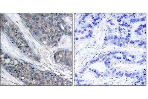 Immunohistochemical analysis of paraffin-embedded human breast carcinoma tissue, using IRS-1 (phospho-Ser307) antibody (E011235). (IRS1 Antikörper  (pSer307))