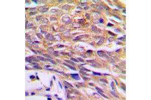 Immunohistochemical analysis of p23 staining in human prostate cancer formalin fixed paraffin embedded tissue section. (CDK5R1 Antikörper  (Center))