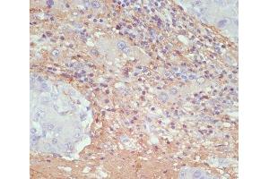Immunohistochemistry of paraffin-embedded Human liver cancer using COL1A1 Polyclonal Antibody at dilution of 1:200 (40x lens). (COL1A1 Antikörper)