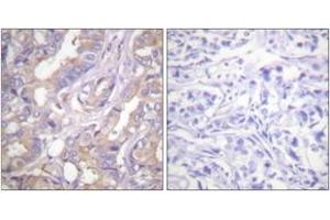Immunohistochemistry analysis of paraffin-embedded human breast carcinoma tissue, using A-RAF (Ab-301/302) Antibody. (ARAF Antikörper  (AA 276-325))