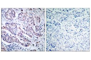 Immunohistochemical analysis of paraffin-embedded human breast carcinoma tissue, using TYK2 (Ab-1054) antibody (E021118). (TYK2 Antikörper)
