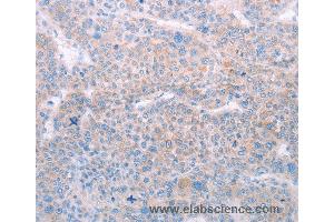 Immunohistochemistry of Human lung cancer using SPATA6 Polyclonal Antibody at dilution of 1:50 (SPATA6 Antikörper)