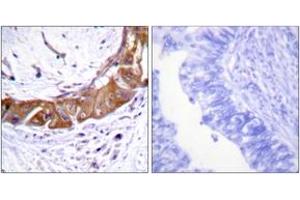 Immunohistochemistry analysis of paraffin-embedded human colon carcinoma, using IRAK1 (Phospho-Thr100) Antibody. (IRAK1 Antikörper  (pThr100))