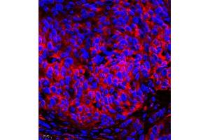 Immunofluorescence of paraffin embedded human cervical cancer using CRMP3 (ABIN7073734) at dilution of 1:650 (400x lens) (DPYSL4 Antikörper)