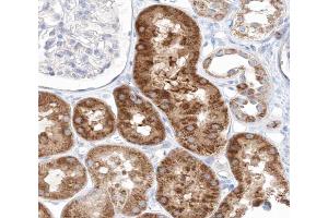 ABIN6267641 at 1/200 staining human kidney carcinoma tissue sections by IHC-P. (eIF4EBP1 Antikörper  (pThr45))