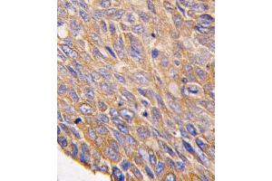 Formalin-fixed and paraffin-embedded human lung carcinoma tissue reacted with TOB2 antibody (N-term), which was peroxidase-conjugated to the secondary antibody, followed by DAB staining. (TOB2 Antikörper  (N-Term))