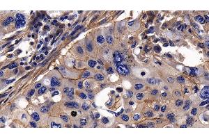 Detection of ITGaV in Human Lung cancer Tissue using Polyclonal Antibody to Integrin Alpha V (ITGaV) (CD51 Antikörper  (AA 560-744))