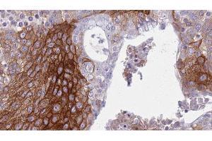 ABIN6272334 at 1/100 staining Human urothelial cancer tissue by IHC-P. (KCNJ3 Antikörper  (Internal Region))