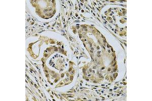 Immunohistochemistry of paraffin-embedded human gastric cancer using LGALS3 Antibody (ABIN5970683) at dilution of 1/200 (40x lens). (Galectin 3 Antikörper)
