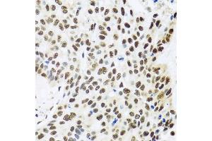 Immunohistochemistry of paraffin-embedded human lung cancer using FUBP1 antibody (ABIN6130392, ABIN6140802, ABIN6140804 and ABIN6221231) at dilution of 1:100 (40x lens). (FUBP1 Antikörper  (AA 302-644))