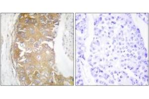 Immunohistochemistry analysis of paraffin-embedded human breast carcinoma tissue, using FRK Antibody. (FRK Antikörper  (AA 71-120))