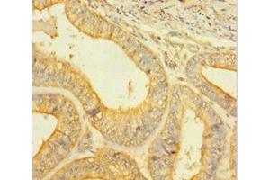 Immunohistochemistry of paraffin-embedded human endometrial cancer using ABIN7146926 at dilution of 1:100 (Caspase 1 Antikörper  (AA 120-269))