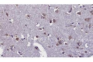 ABIN6276443 at 1/100 staining Human brain cancer tissue by IHC-P. (TLR7 Antikörper  (Internal Region))