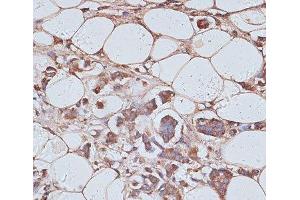 Immunohistochemistry of paraffin-embedded Human breast cancer using TAX1BP1 Polyclonal Antibody at dilution of 1:100 (40x lens). (TAX1BP1 Antikörper)