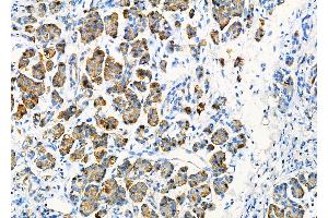 ABIN6264112 and ABIN6277799 at 1/100 staining Human pancreatic cancer and adjacent nomal tissues by IHC-P.