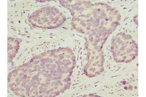 Immunohistochemistry of paraffin-embedded human gastric cancer using ABIN7162208 at dilution of 1:100 (Oligophrenin 1 Antikörper  (AA 1-270))