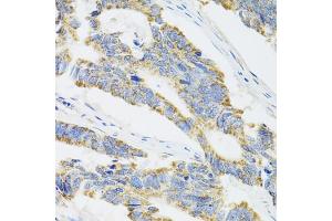 Immunohistochemistry of paraffin-embedded human colon carcinoma using CYP1A1 antibody.