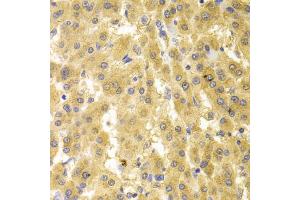 Immunohistochemistry of paraffin-embedded human liver cancer using GMNN antibody. (Geminin Antikörper)