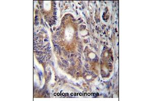 RAB21 Antibody (C-term) (ABIN657300 and ABIN2846383) immunohistochemistry analysis in formalin fixed and paraffin embedded human colon carcinoma followed by peroxidase conjugation of the secondary antibody and DAB staining. (RAB21 Antikörper  (C-Term))