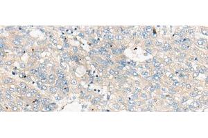 Immunohistochemistry of paraffin-embedded Human liver cancer tissue using ZNF449 Polyclonal Antibody at dilution of 1:50(x200) (ZNF449 Antikörper)