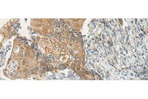 Immunohistochemistry of paraffin-embedded Human cervical cancer tissue using VIPR2 Polyclonal Antibody at dilution 1:35