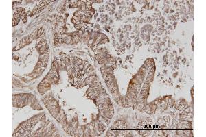 Immunoperoxidase of monoclonal antibody to ERBB3 on formalin-fixed paraffin-embedded human lung cancer. (ERBB3 Antikörper  (AA 21-331))