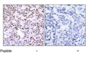 Immunohistochemical analysis of paraffin-embedded human breast carcinoma tissue using CHEK2 polyclonal antibody  . (CHEK2 Antikörper)