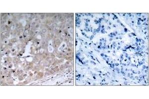 Immunohistochemistry analysis of paraffin-embedded human breast carcinoma tissue, using VEGFR2 (Ab-1175) Antibody. (VEGFR2/CD309 Antikörper  (AA 1141-1190))