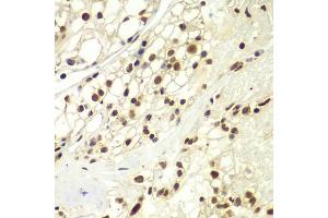 Immunohistochemistry of paraffin-embedded human kidney cancer using RPA2 Antibody (ABIN5971215) at dilution of 1/100 (40x lens). (RPA2 Antikörper)