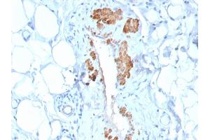 Formalin-fixed, paraffin-embedded human Breast Carcinoma stained with SM-MHC Recombinant Rabbit Monoclonal Antibody (MYH11/2303R). (Rekombinanter MYH11 Antikörper)