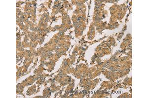 Immunohistochemistry of Human breast cancer using DMRT3 Polyclonal Antibody at dilution of 1:50 (DMRT3 Antikörper)