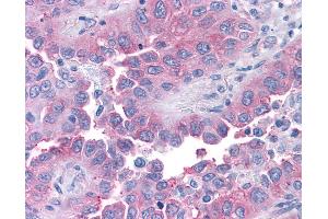 Anti-T1R1 / TAS1R1 antibody IHC of human Lung, Non-Small Cell Carcinoma. (TAS1R1 Antikörper  (Cytoplasmic Domain))