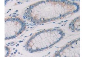 Detection of RNASE10 in Human Colorectal cancer Tissue using Polyclonal Antibody to Ribonuclease A10 (RNASE10) (Ribonuclease A10 (AA 27-216) Antikörper)